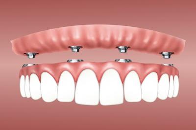 implant dentaire reims